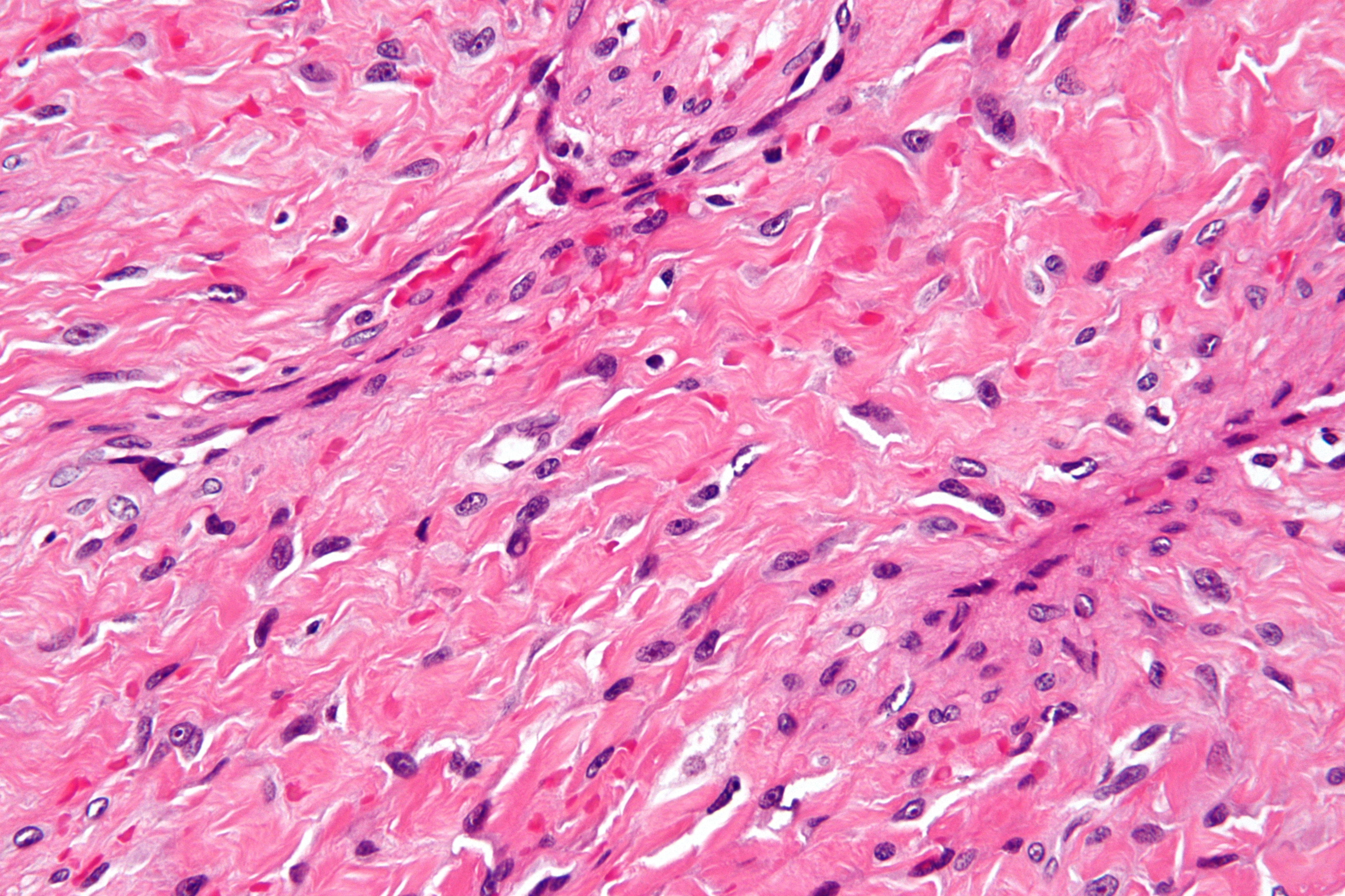 <p>Nasopharyngeal Angiofibroma Histopathology