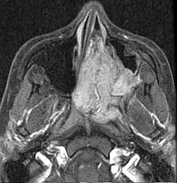 <p>Nasopharyngeal Angiofibroma on Computed Tomography Angiography