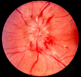 <p>Papilledema on Funduscopy