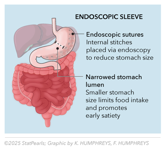 <p>Endoscopic Sleeve