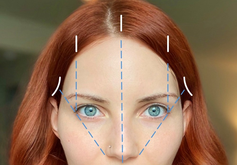 <p>Endoscopic Brow Lift Incisions