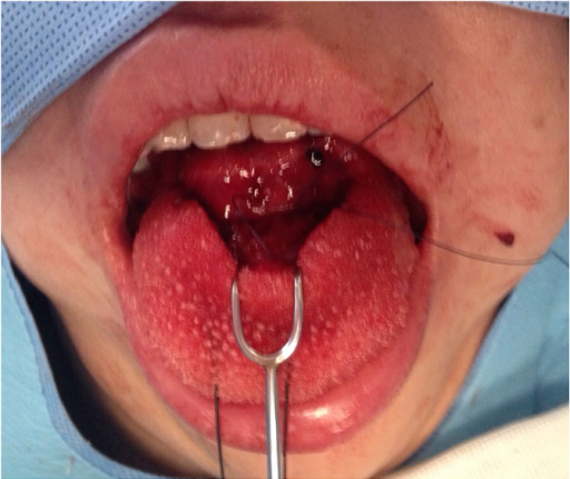 <p>Dorsum of the Tongue With Transverse Partial-Thickness Laceration