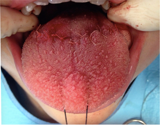 <p>Complete Repair Showing Appropriate Continuity of the Tongue
