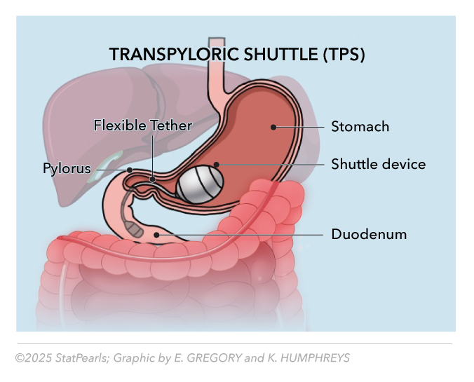 <p>Transpyloric Shuttle (TPS)