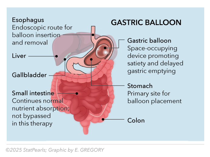 <p>Gastric Balloon