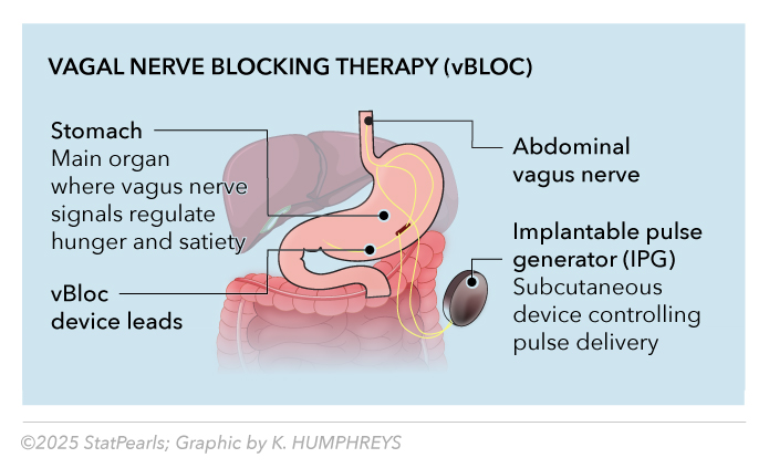 Vagal Nerve Blocking Therapy (vBLOC)