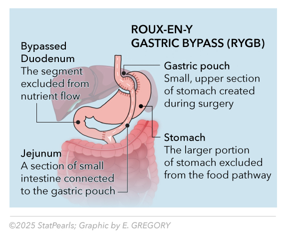 <p>Roux-en-Y Gastric Bypass (RYGB)</p>