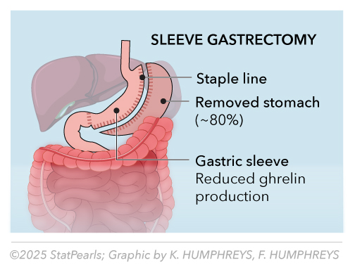 Sleeve Gastrectomy