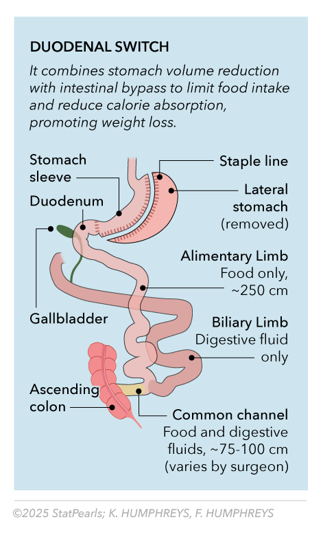 <p>Duodenal Switch</p>