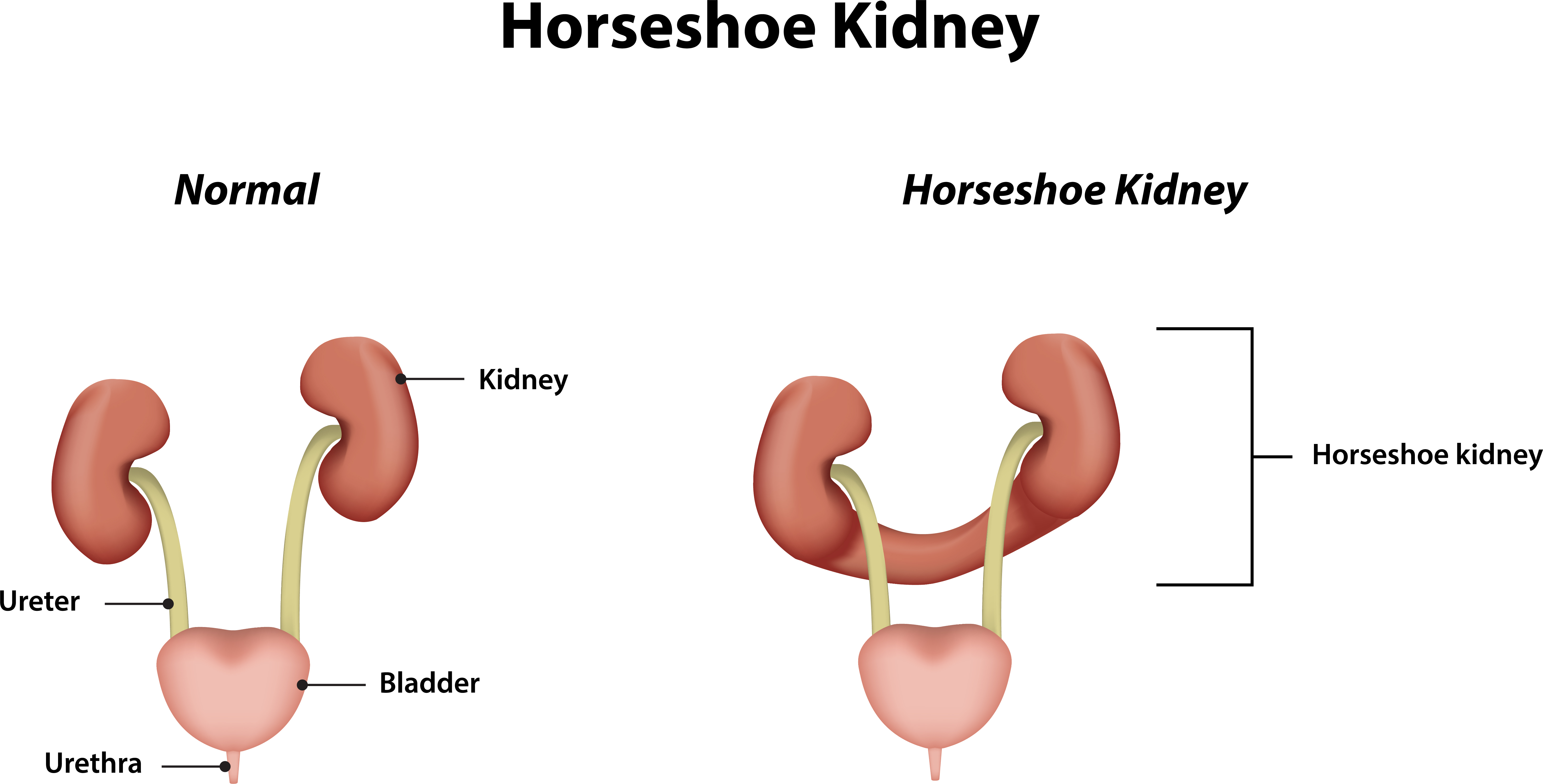 Horseshoe Kidney.