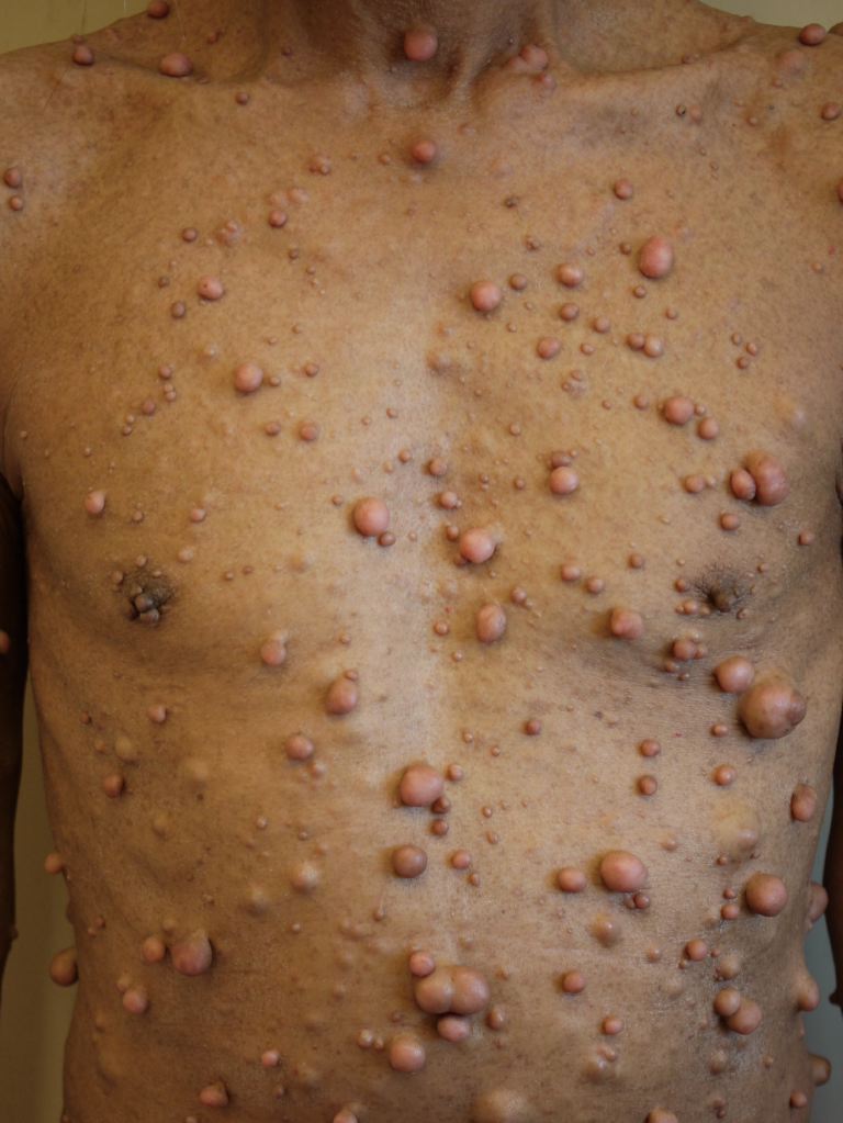 <p>Neurofibromatosis