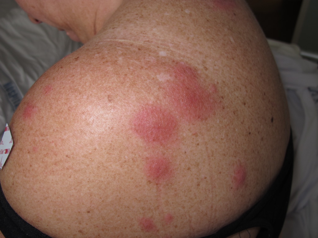 <p>Neutrophic Dermatosis</p>