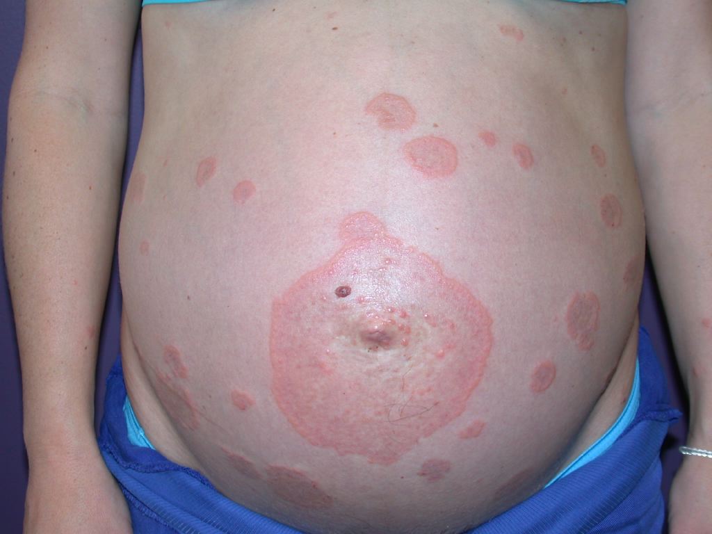 <p>Abdominal Pemphigoid Gestationis</p>