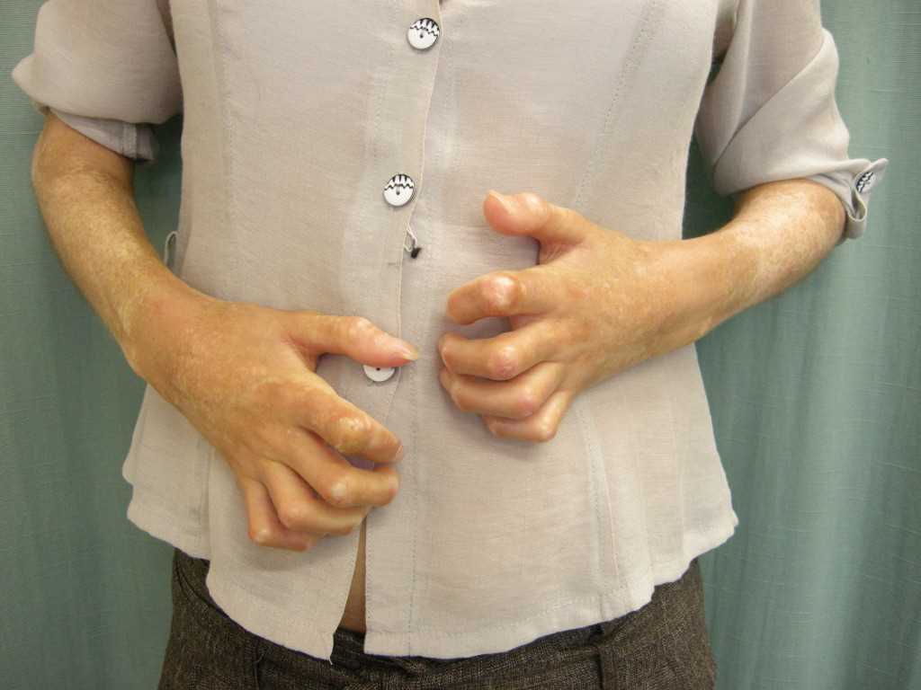 <p>Bilateral Signs of Raynaud Phenomenon in a Patient's Hands
