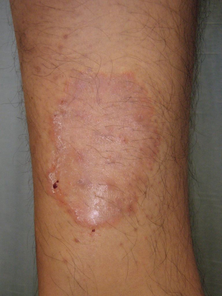 <p>Tinea Corporis of the Forearm