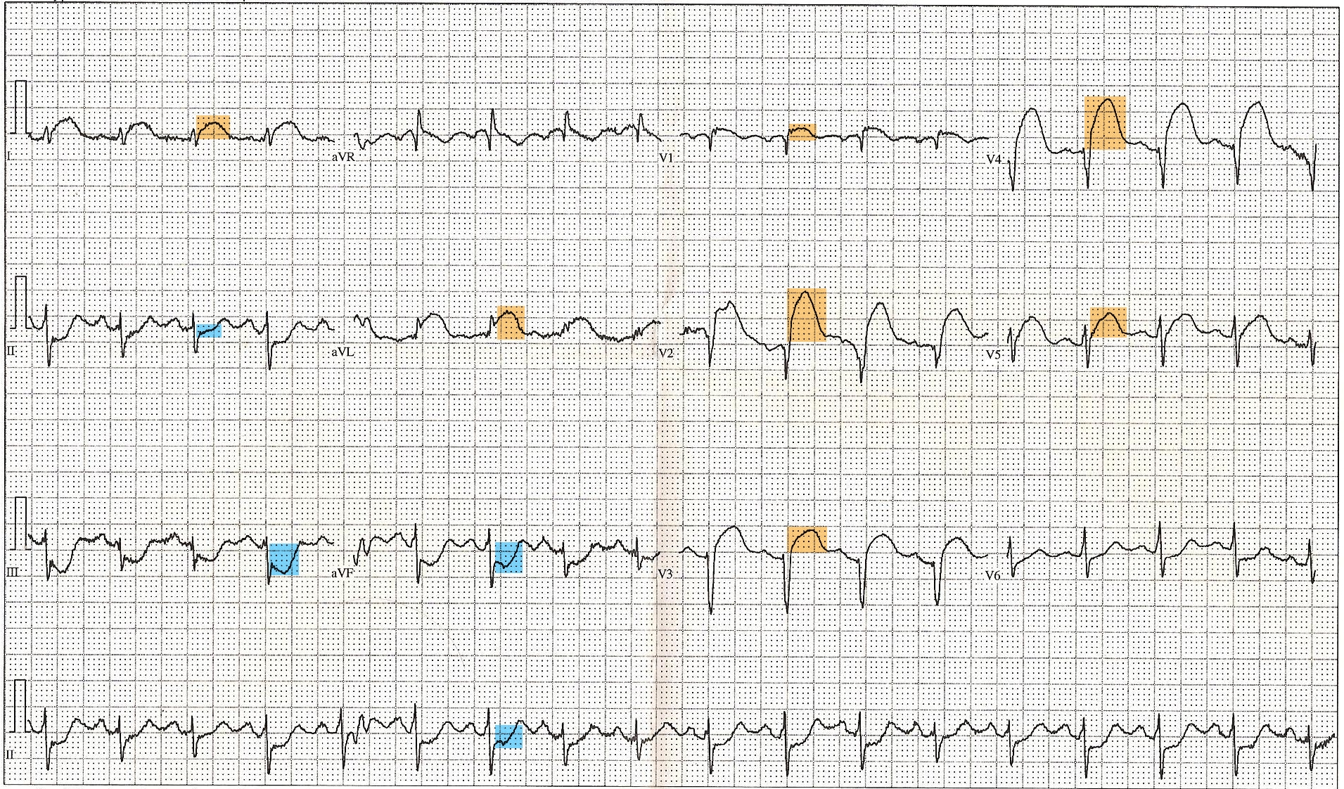 <p>&nbsp;ST-Elevated Myocardial Infarction on Electrocardiogram
