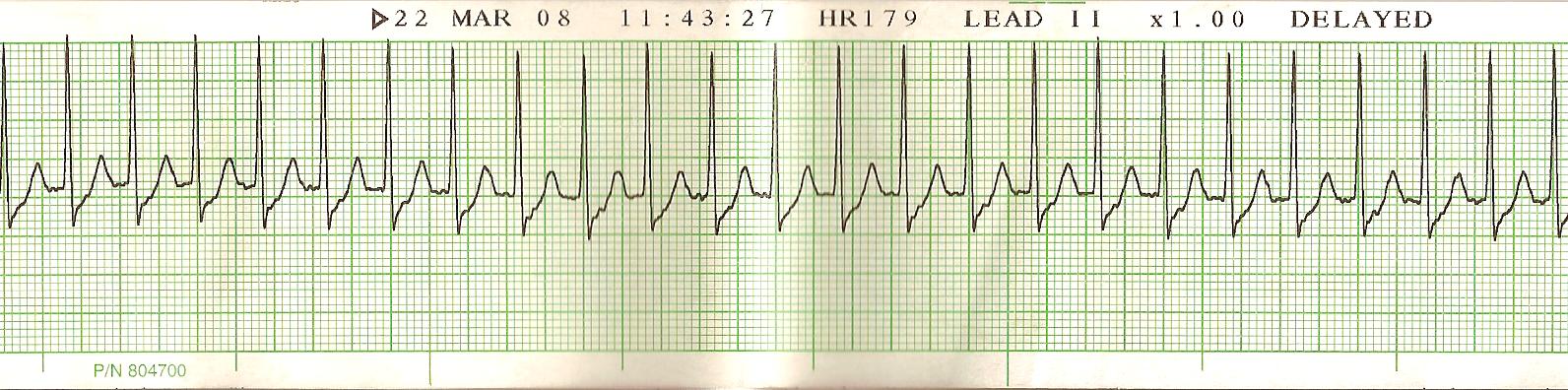 <p>Supraventricular Tachycardia. ECG tracing of lead 2 shows supraventricular tachycardia. ECG, electrocardiogram.</p>