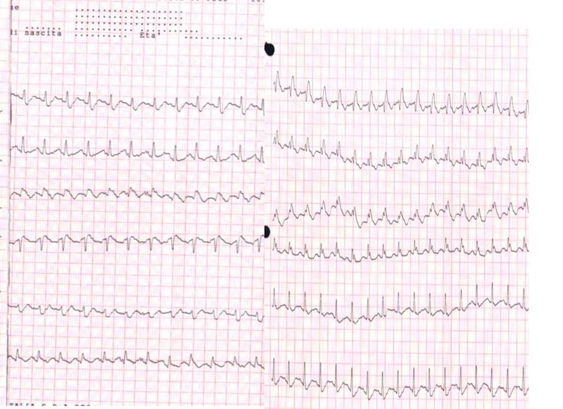 <p>Electrocardiogram, Pulmonary Embolism