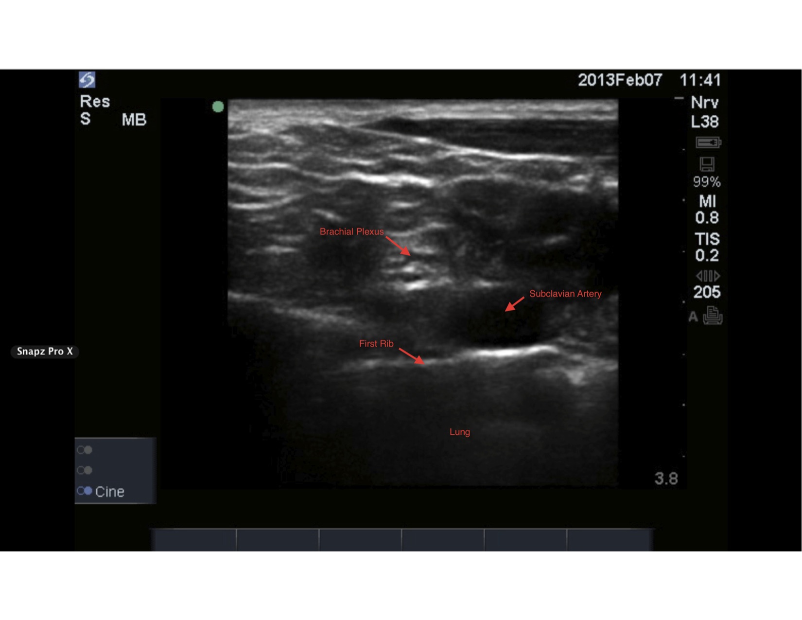 <p>Supraclavicular Ultrasound-Guided, Brachial Plexus Nerve Block