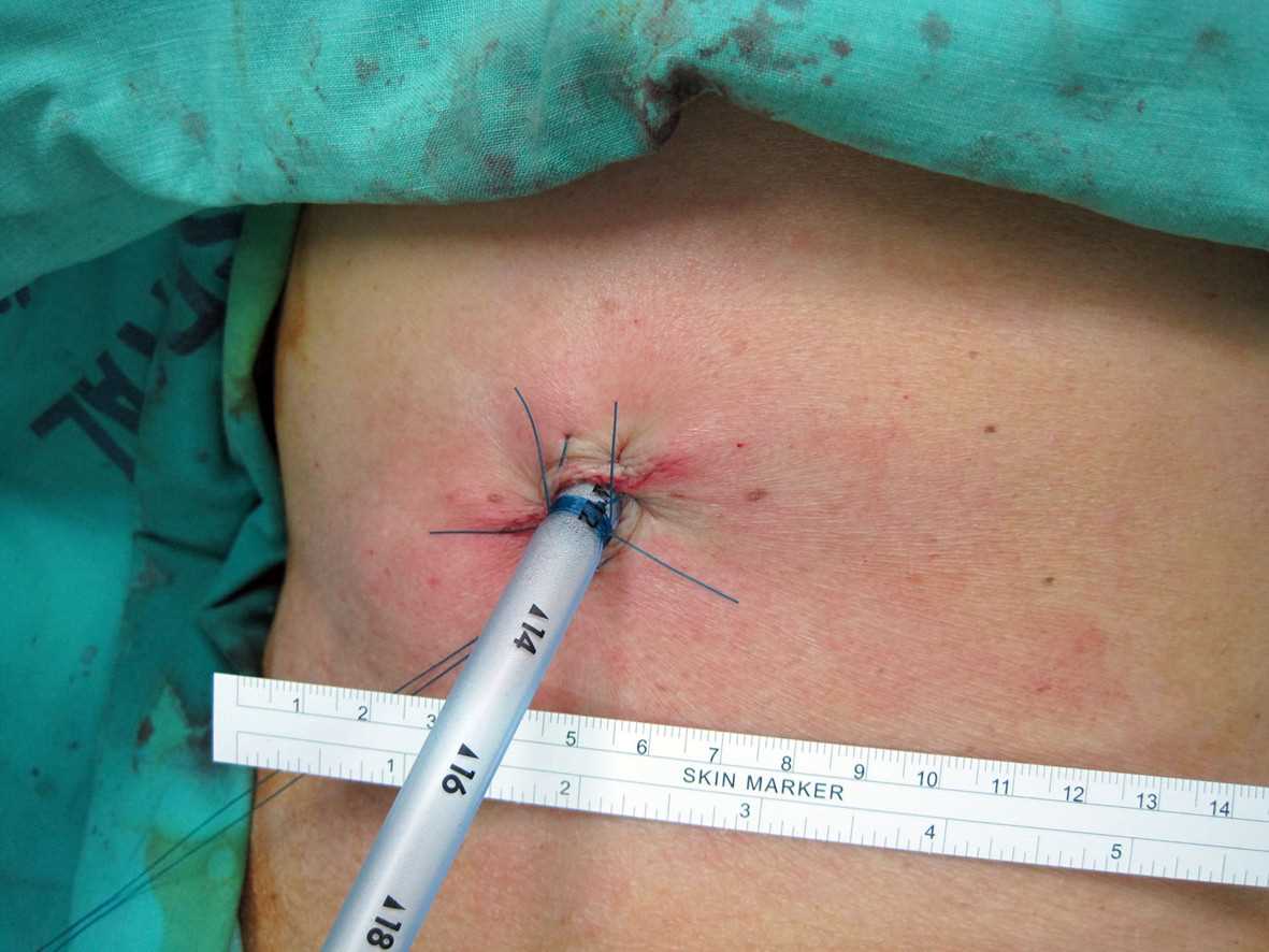 <p>Surgically-Placed Chest Tube