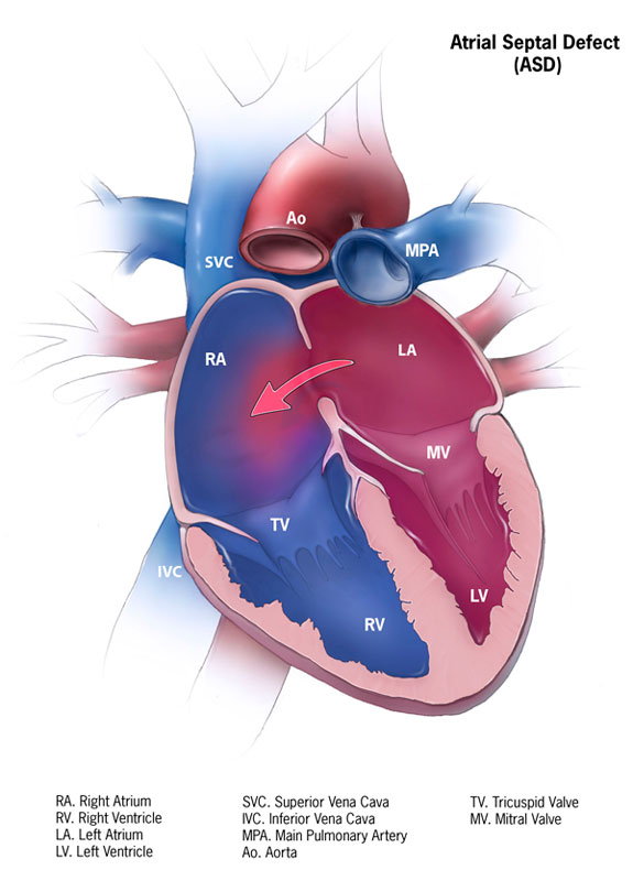 <p>Atrial Septal Defect