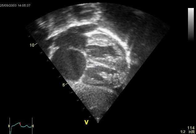 <p>Ostium Secundum Atrial Septal Defect on Ultrasound