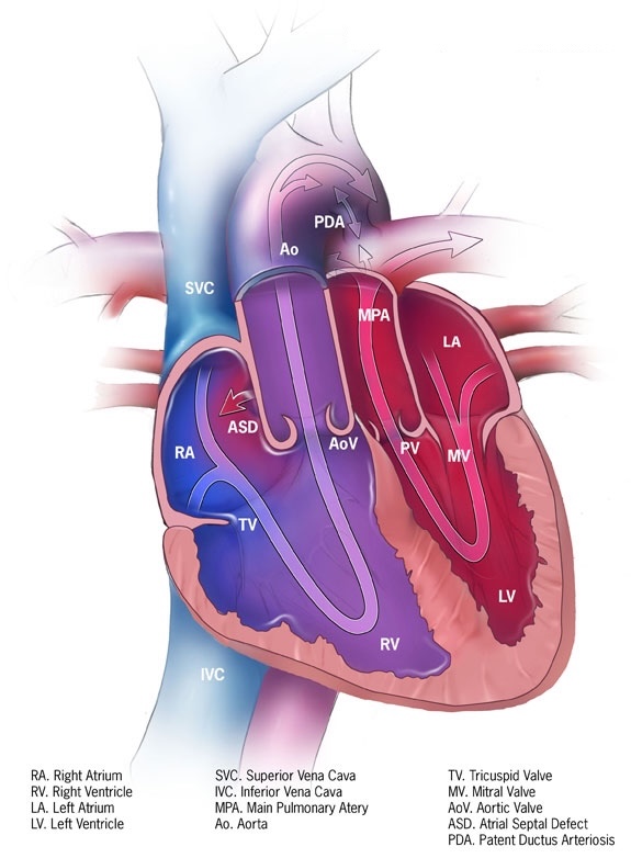 <p>Dextro-Transposition of the Great Arteries