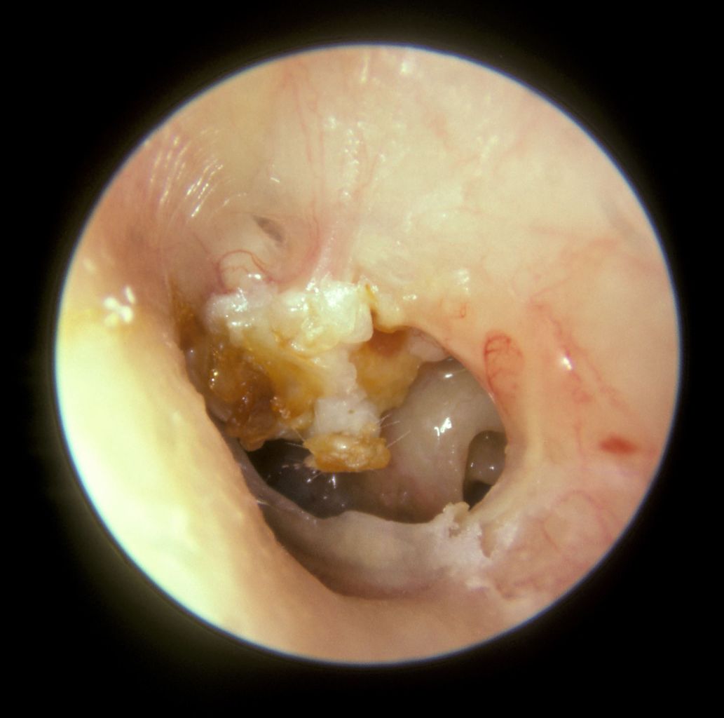 <p>Cholesteatoma