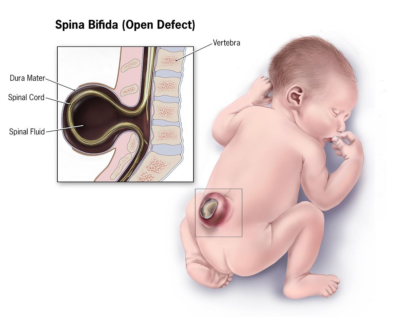 <p>Infant With Spina Bifida. This illustration depicts the characteristic features of an infant with spina bifida.</p>