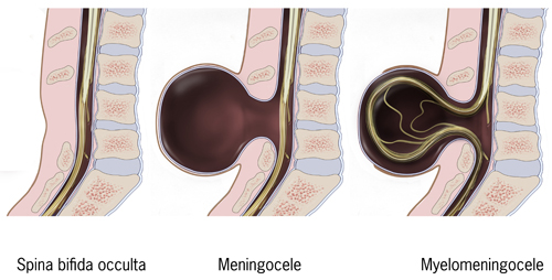 <p>Types of Spina Bifida