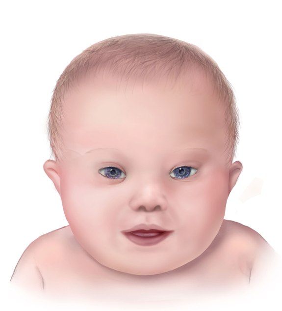 A drawing of the facial features of Down syndrome