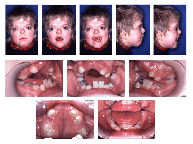 <p>Craniofacial and Oral Findings in Apert Syndrome