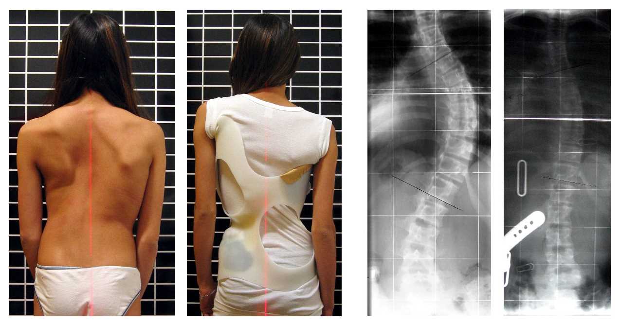 <p>Patient With Scoliosis&nbsp;in Ch&ecirc;neau Brace