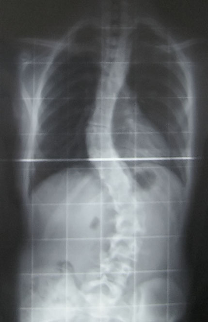 <p>Adolescent Idiopathic Scoliosis