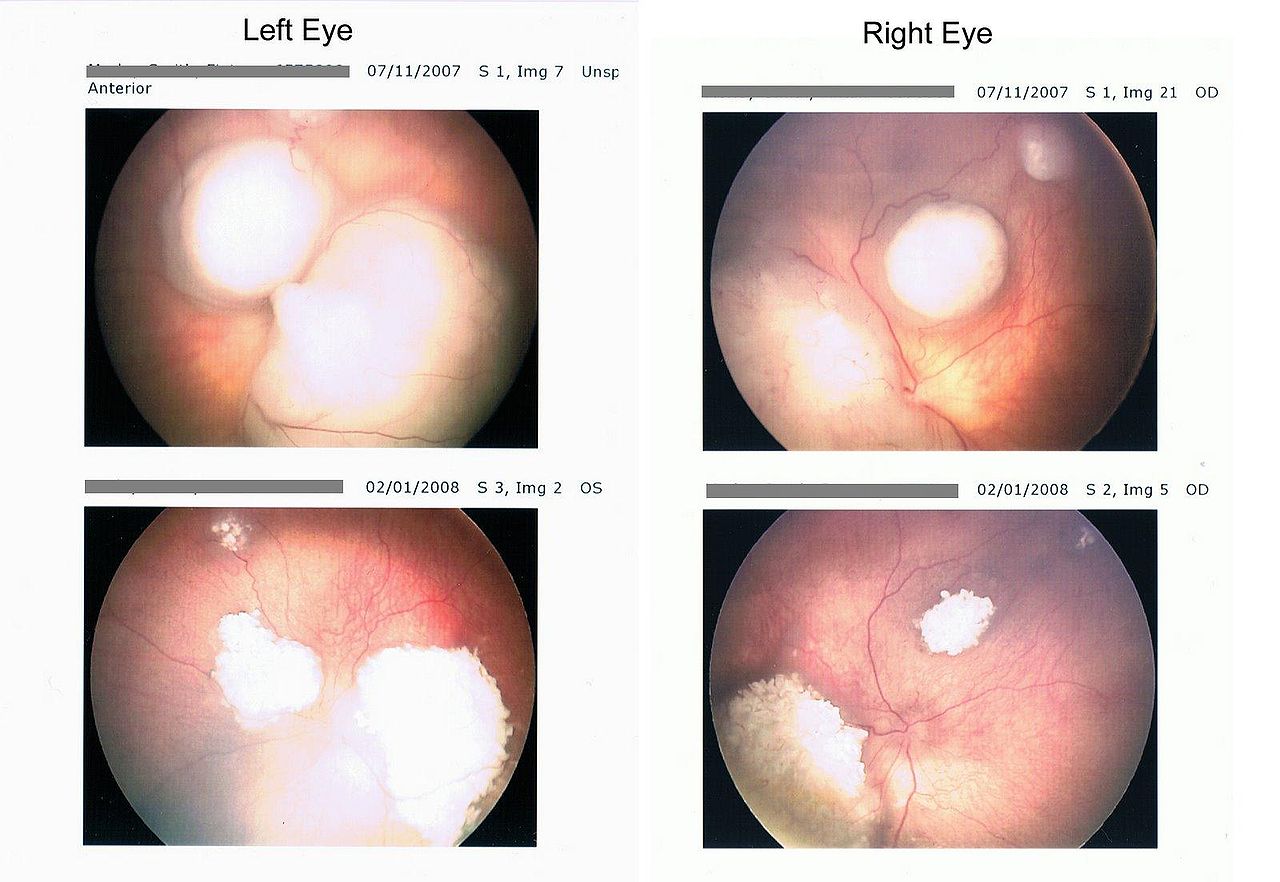 <p>Retinoblastoma Retina Scan