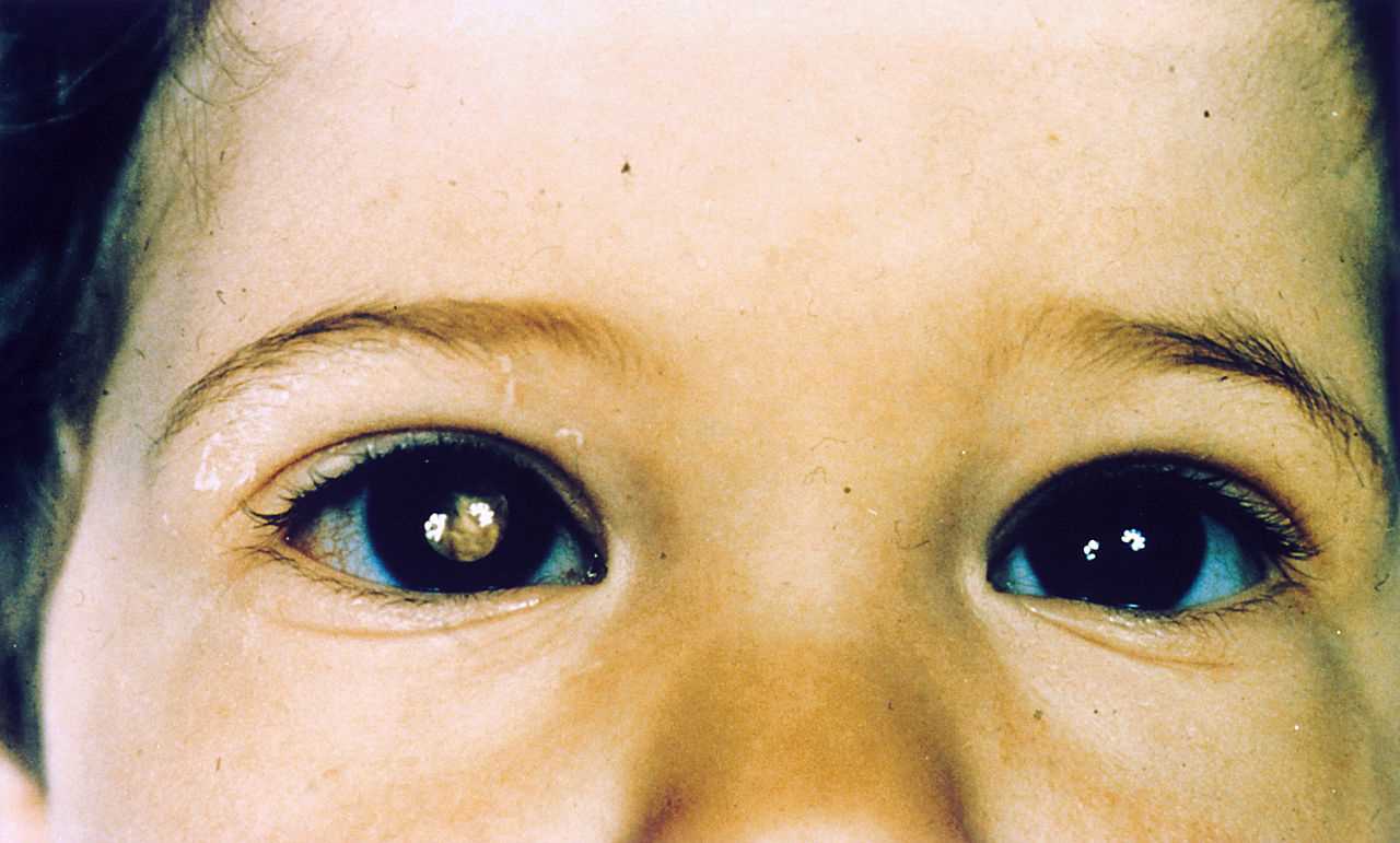 <p>Patient with Retinoblastoma