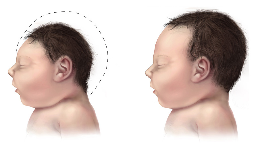 <p>Fetal Microcephaly