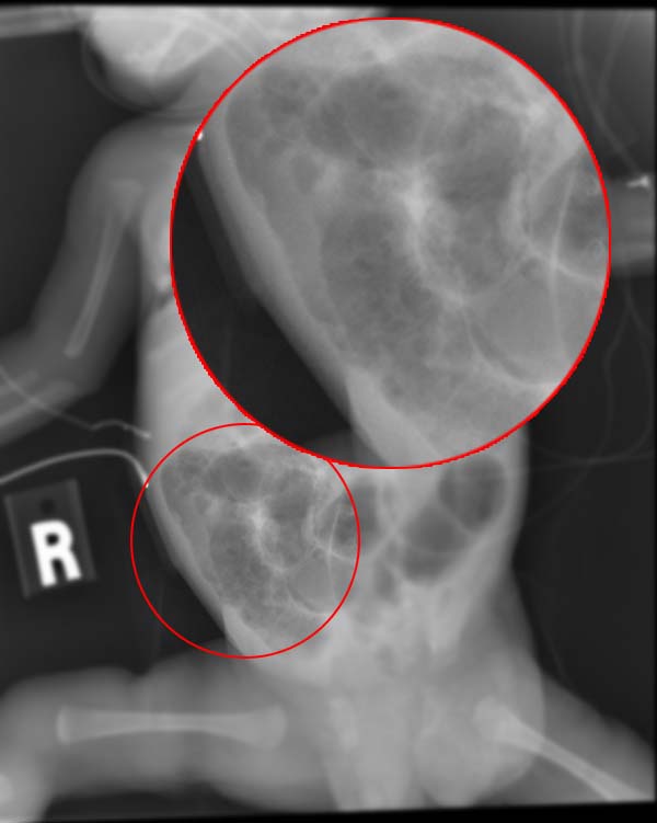 <p>&nbsp;Infant With Necrotizing Enterocolitis, Radiograph