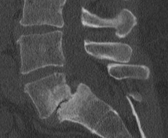 <p>Grade II Spondylolisthesis. Lumbar spine sagittal CT of L5-S1 revealing grade II spondylolisthesis.</p>