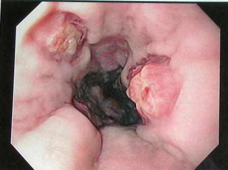 <p>Postbanding Esophageal Ulcers