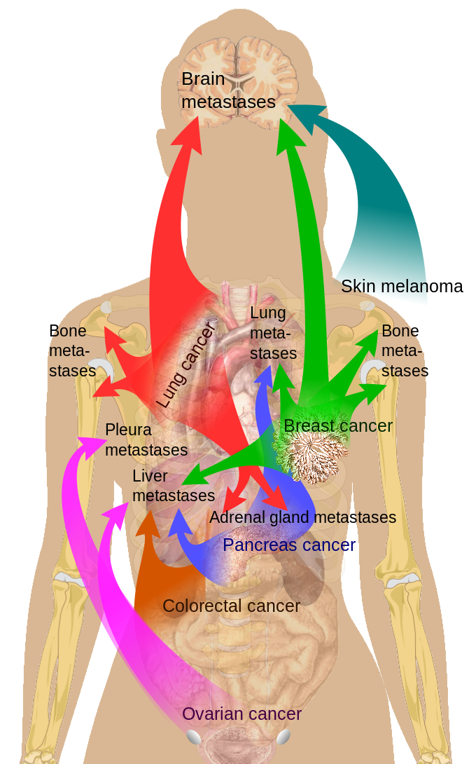 <p>Common Sites of Breast Cancer Metastasis.</p>