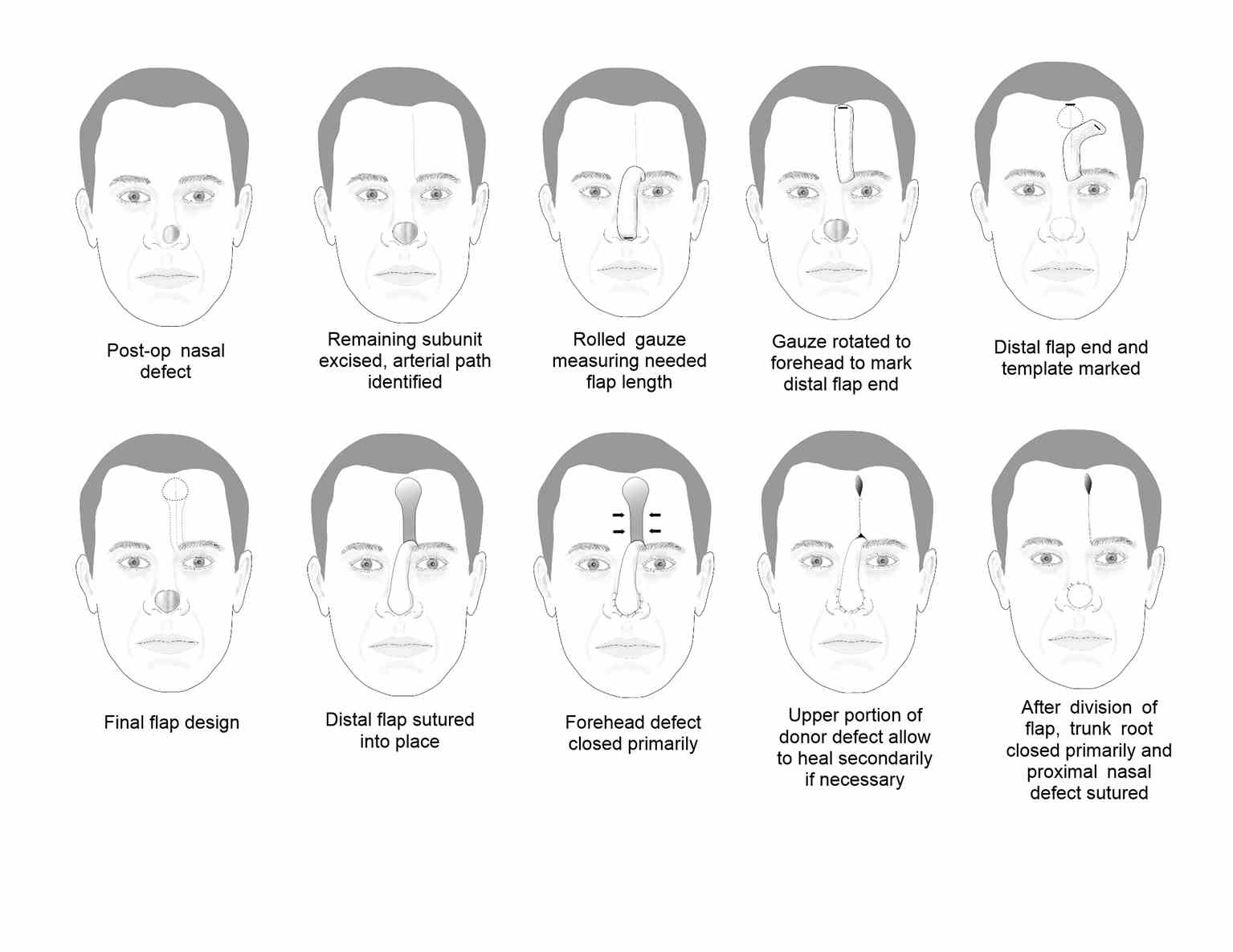 <p>Forehead Flap Summary Diagrams</p>