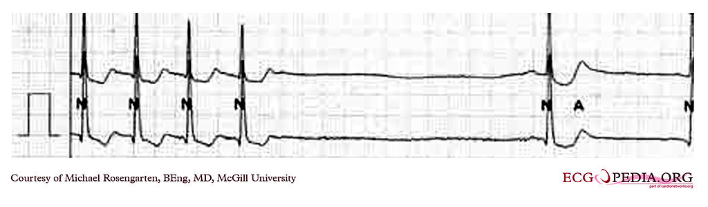 <p>Supraventricular Tachycardia Termination