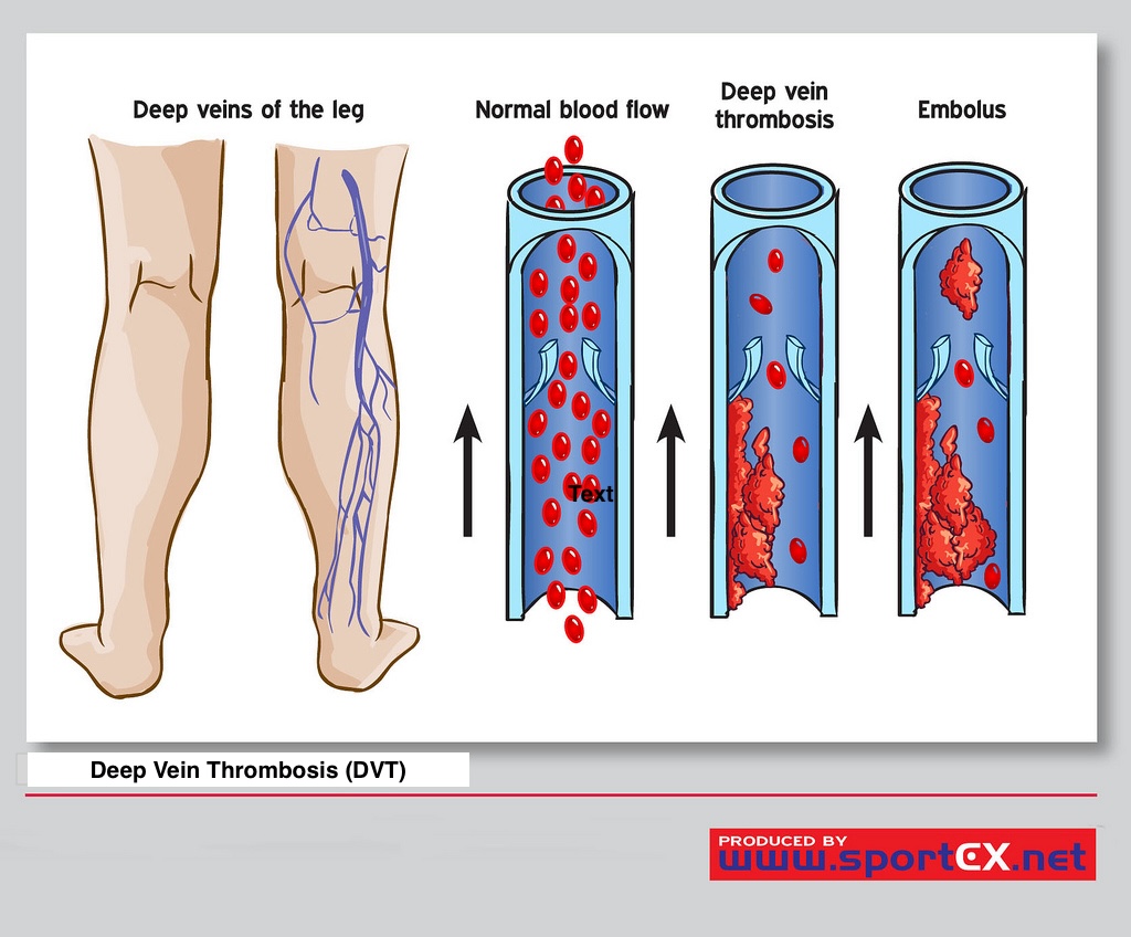 <p>Deep Vein Thrombosis
