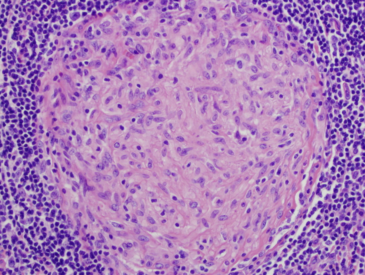 Picture of a granuloma (without necrosis) as seen through a microscope on a glass slide