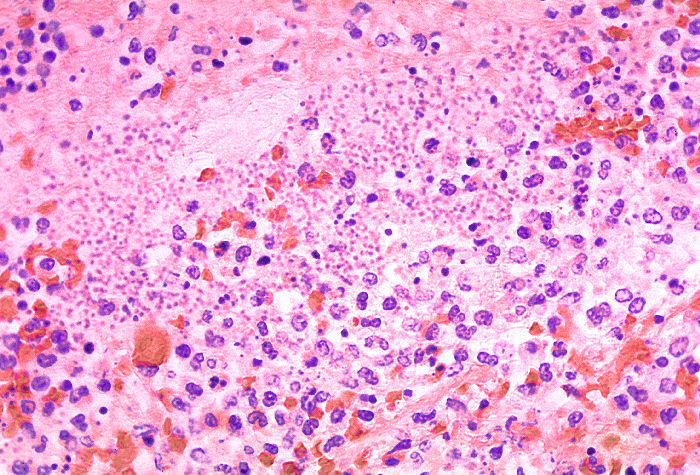 <p>Histological Section of Pneumonia-Affected Lung.</p>
