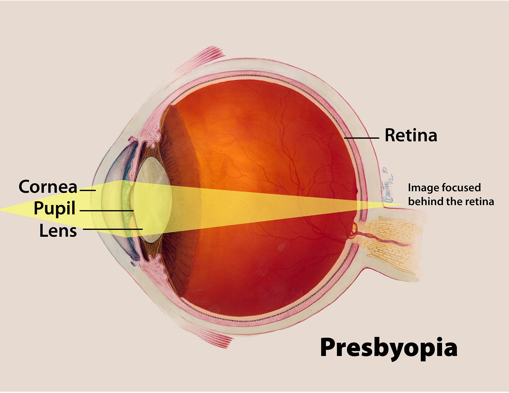 <p>Presbyopia: Age-Related Loss of Near Vision Focus
