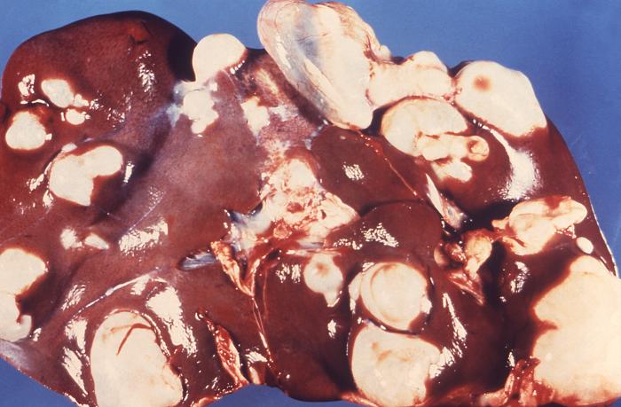 Sheep's Liver, Cysts, Hepatic echinococcosis due to tapeworm, Echinococcus granulosus, Pathology, Parasitology