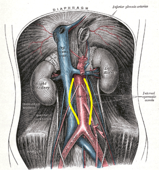 <p>Abdominal Aortic Aneurysm, Illustration