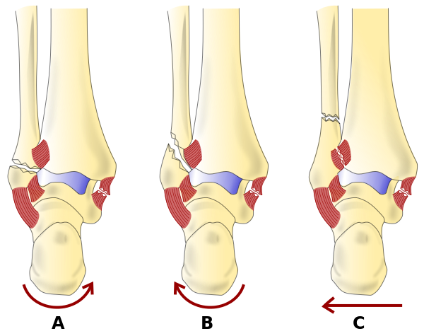 <p>Weber Classification of Ankle Fractures.&nbsp;</p>